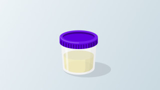 Urine sample container representing a biological sample for biomarker analysis, illustration.
